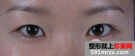 ȫ���p��Ƥ+�_�۽ǻ֏�ǰ�󌦱���Ƭ�D