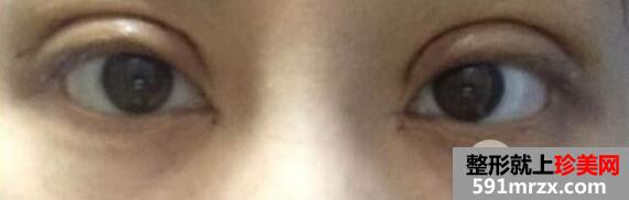 ȫ���p��Ƥ+�_�۽ǻ֏�ǰ�󌦱���Ƭ�D