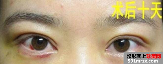 ȫ���p��Ƥ+�_�۽ǻ֏�ǰ�󌦱���Ƭ�D