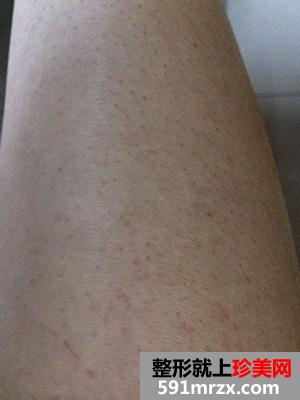 ����Ó��ë�Æ᣿�����ҵ�ǰ�󌦱�Ч���DƬ�ͻ֏�(f��)�^�̾�֪������