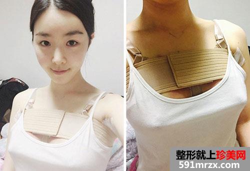 ����ˮ���μ��w¡���g(sh��)ǰ��Ч����(du��)���պͻ֏�(f��)�^(gu��)�̷���