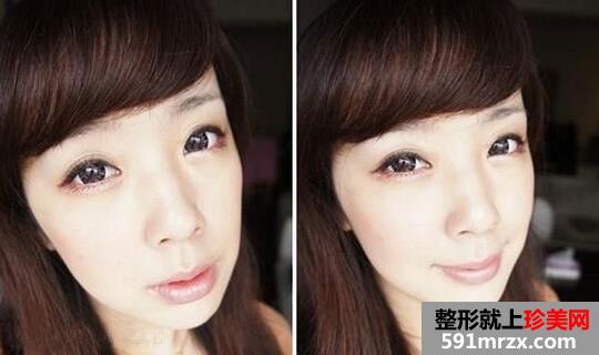 ��botox��Ęᘌ��F���Z��Ę�ĉ���