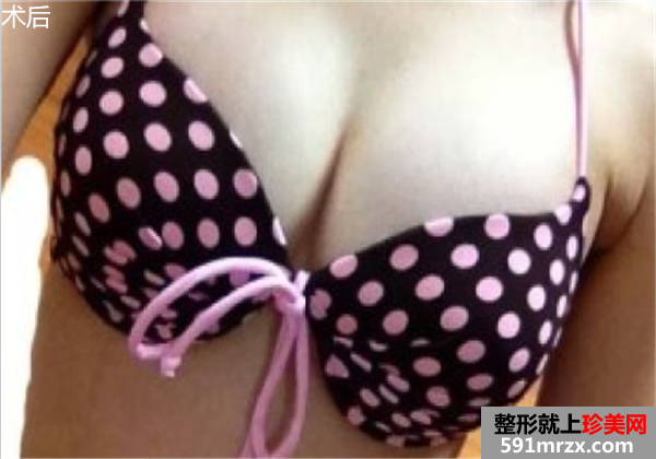 ���w֬���(x��)���S�����g(sh��)ǰ��Ч�����ȈDƬ�ͻ֏�(f��)�^�̷���