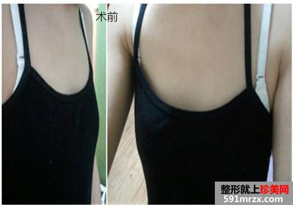 ���w֬���(x��)���S�����g(sh��)ǰ��Ч�����ȈDƬ�ͻ֏�(f��)�^�̷���