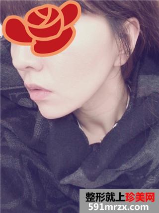 �����沿�����gȥ����yǰ�󌦱�Ч���DƬ�ͻ֏��^��
