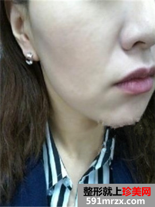 �����沿�����gȥ����yǰ�󌦱�Ч���DƬ�ͻ֏��^��