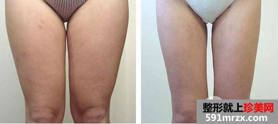 ������֬���g(sh��)Ҫ�����X ������֬���ε�ע�����(xi��ng)����Щ