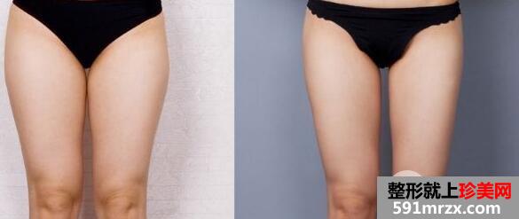 ������֬���g(sh��)Ҫ�����X ������֬���ε�ע�����(xi��ng)����Щ