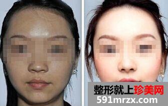 ����ᘶ����Xһ���� �����Ч���Dǰ�󌦱�