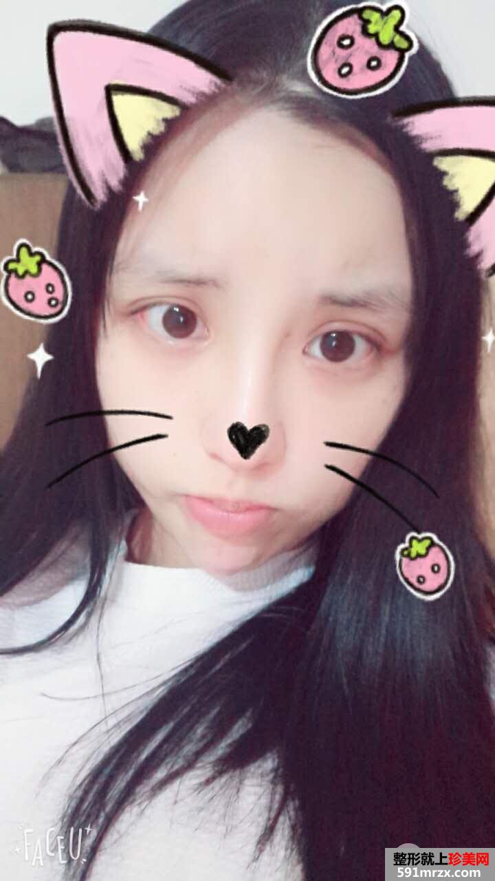 PRP���w֬���沿���Ч���D���� ֬������ʸ���