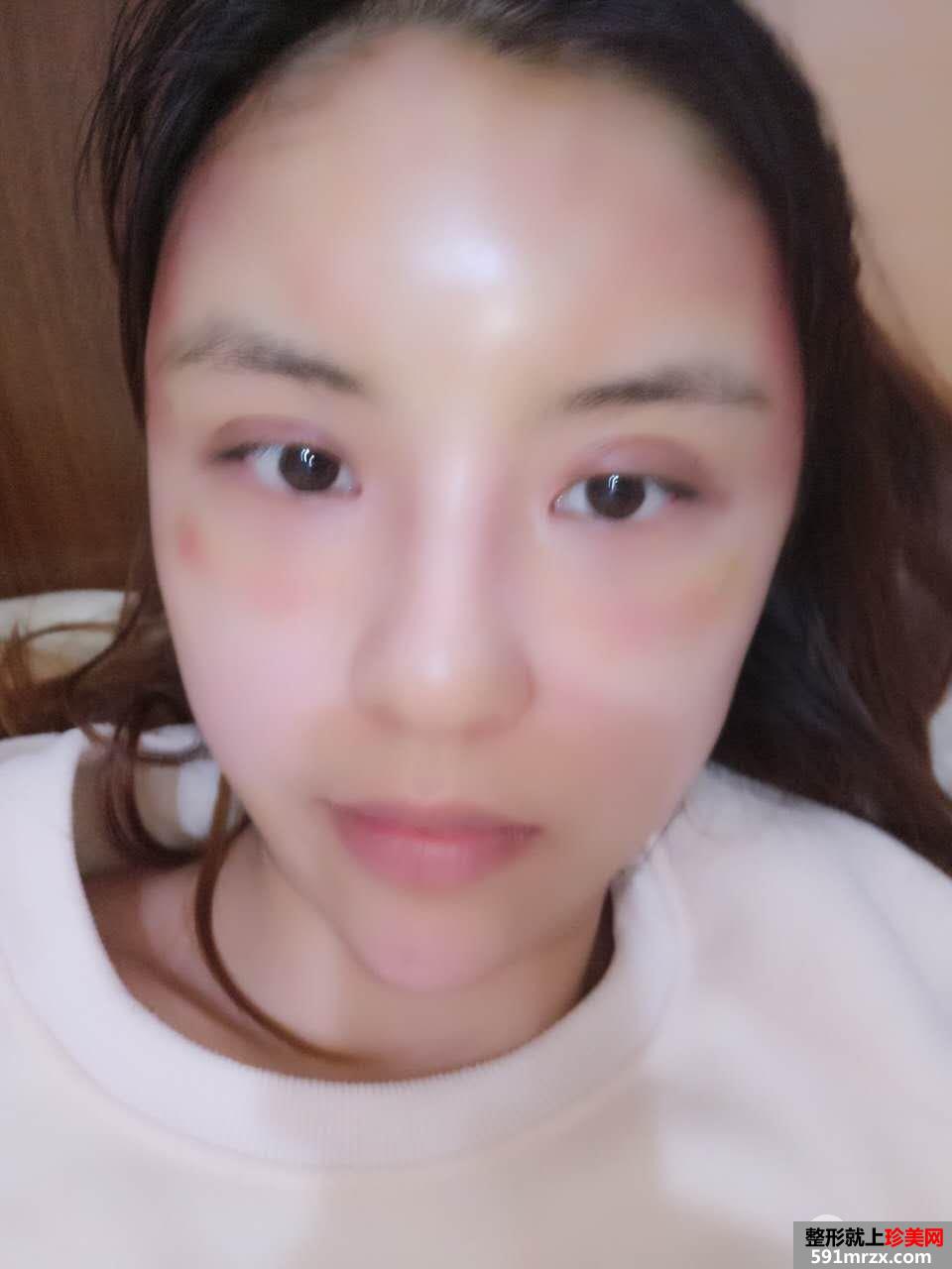 PRP���w֬���沿���Ч���D���� ֬������ʸ���
