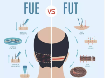����FUE�Nֲ�^�l(f��)�ļ��t(y��)Ժ�ã�