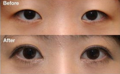 ���p��ƤЧ��