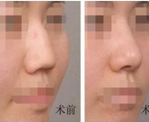 駝峰鼻矯正前后對比照 駝峰鼻矯正前后對比照