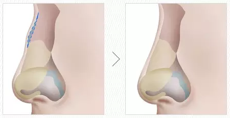 駝峰鼻矯正前后對比照片 駝峰鼻矯正前后對比照片