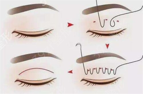 全國(guó)修復(fù)雙眼皮好的醫(yī)生排名_全新排名