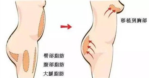 全國(guó)口碑好的隆胸專家排行榜列表前五發(fā)布