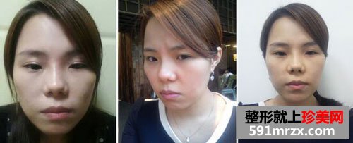 �nʽ�o���_�۽�+���w¡���������g(sh��)ǰ�󌦱ȈD�ͻ֏�(f��)�^��